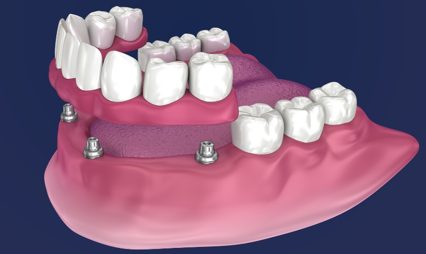 Implant Overdentures- implants life