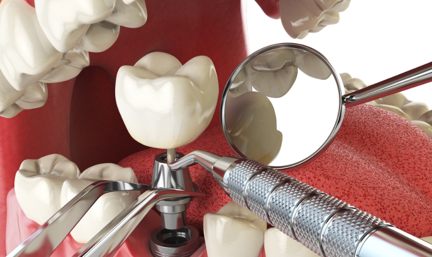Same Day Dental Implants-Implants Life